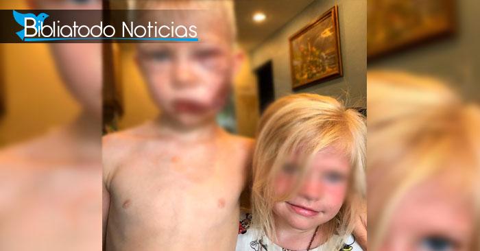 Niño de 6 años salva a su hermana del ataque de un perro y su cara queda desfigurada (FUERTES IMÁGENES)